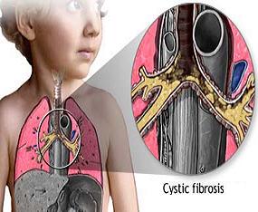 مقاله تاریخچه فیبروز کیستیک (CF)